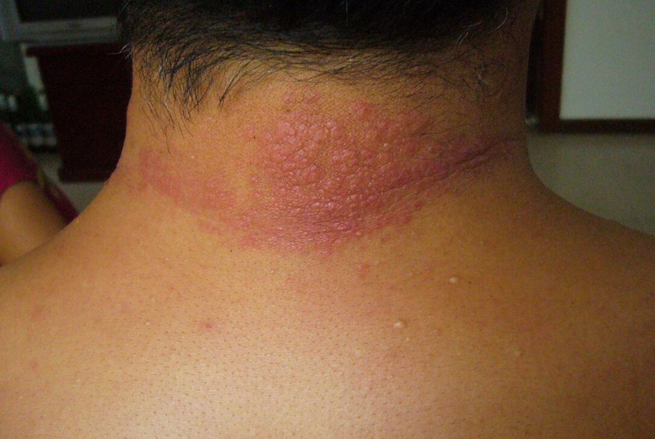 紫外线过敏怎么办 它有哪些症状表现