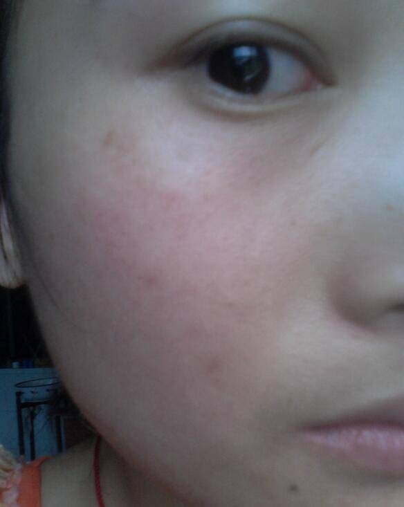 紫外线过敏怎么办 它有哪些症状表现