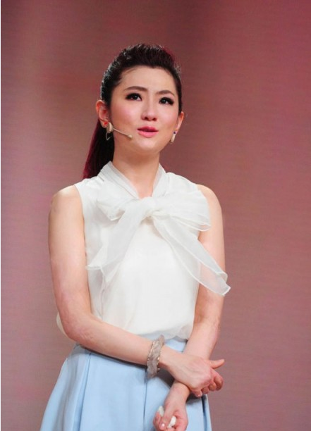 selina离婚真相大揭秘 selina烧伤前后照片对比