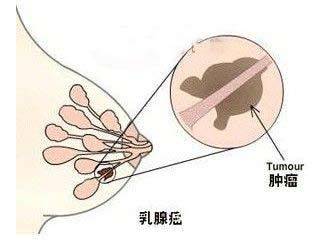 职场女性为什么乳腺癌高发 我们该如何爱护乳房