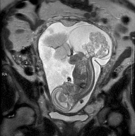 胎儿23周被取出子宫 手术后放回32周健康出生