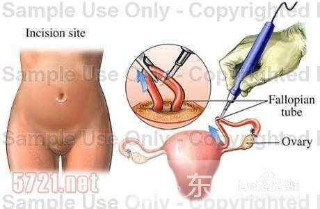 宫外孕怎么办 宫外孕出血怎么办