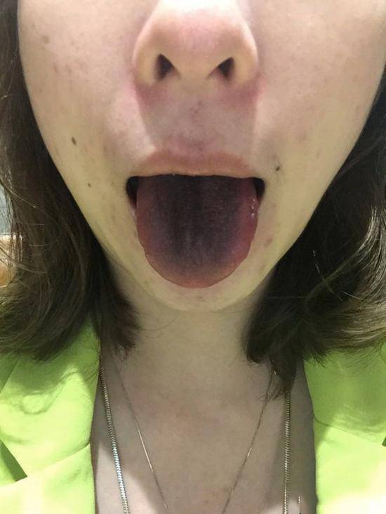 女子吃火锅舌头变黑 商家竟这么解释