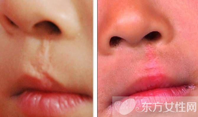 李嫣兔唇原因 李嫣护姐对抗网友获赞 中国好姐妹