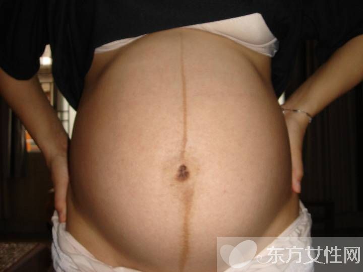 妊娠线可以判断生男生女 产后如何消除妊娠线