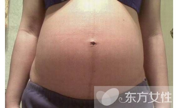 妊娠线可以判断生男生女 产后如何消除妊娠线