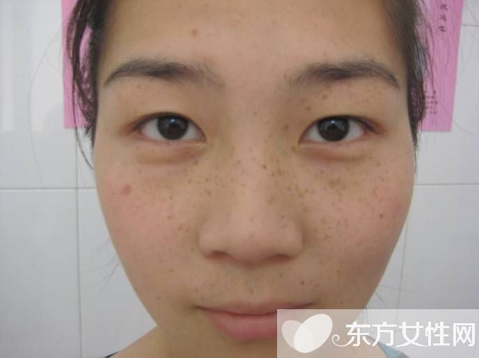 产后黄褐斑怎么去掉 这些方法试过的都说好