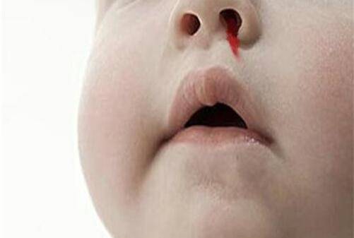 宝宝流鼻血要警惕 可能是白血病惹的祸