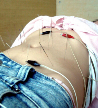 针灸减肥 针灸减肥十大常见问题