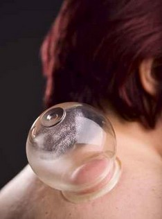 拔火罐拔出水泡 拔火罐起水泡的预防方法