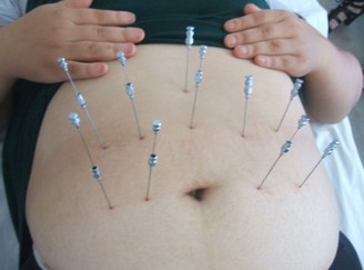 埋线减肥 什么人适合做埋线减肥