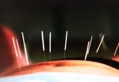 针灸减肥 调整新陈代谢和内分泌功能