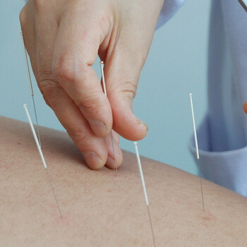 如何进行针灸 注意针灸减肥的四大误区