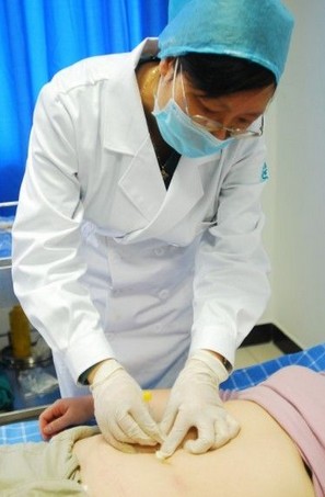 穴位埋线减肥 埋线减肥的注意事项