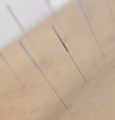 如何针灸减肥 针灸减肥要使用一次性毫针