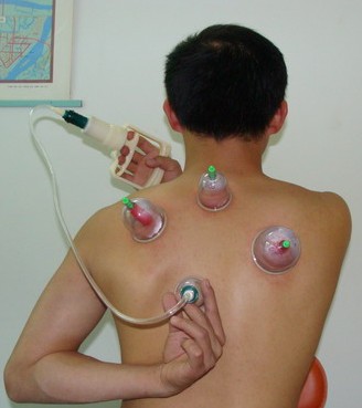 拔罐减肥 关元与气海穴有增补元气的作用