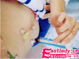 针灸减肥瘦身能成为瘦身绝招吗