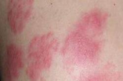 猩红热症状有哪些呢 患有猩红热会有后遗症吗