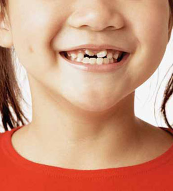 什么是六龄牙  六龄牙对儿童有哪些影响