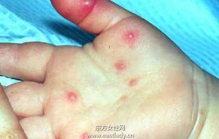 婴幼儿得皮疹如何护理