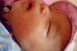 婴儿奶癣的症状表现 这么做可有效预防奶癣哦