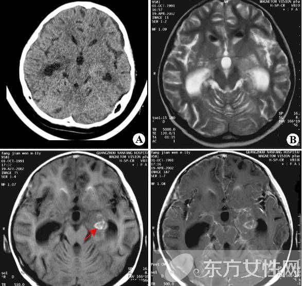 脑膜炎有什么症状 脑膜炎是什么原因引起的
