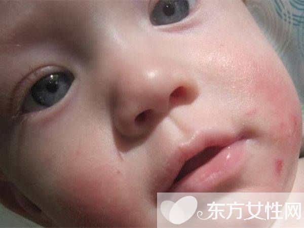 婴儿奶癣的症状表现 这么做可有效预防奶癣哦