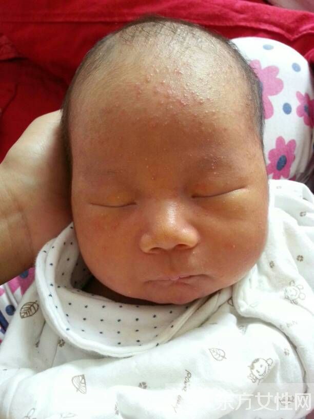 宝宝湿疹最佳治疗方法 做好预防措施让宝宝健康成长