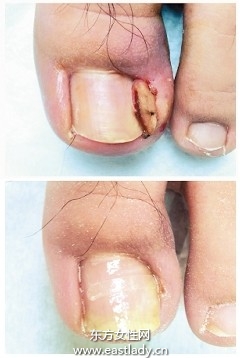 鞋子穿太小男童甲沟炎化脓