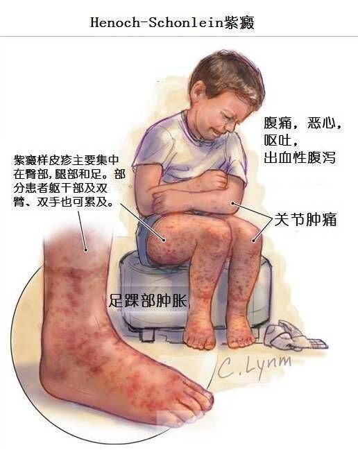 什么是小儿紫癜病 出现这些症状千万不能马虎