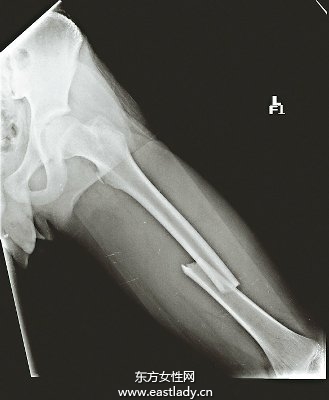 少年1年内二次大腿骨骨折 原因居然是...