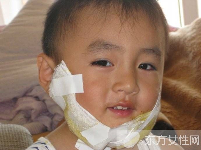 小儿腮腺炎的治疗 这些偏方巧治儿童腮腺炎