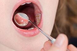 孕妇口腔溃疡怎么办 如何巧治孕妇口腔溃疡