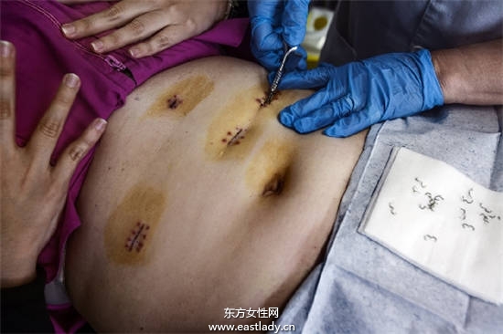 120公斤胖妹做胃绕道减肥手术暴减50公斤恢复自信