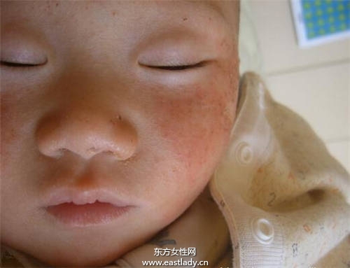 宝宝脸上长小疙瘩妈妈误以为是痱子 差点给宝宝毁容