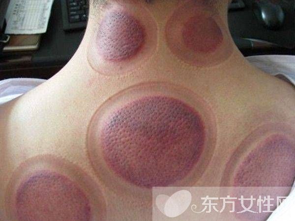拔火罐减肥的好处与坏处 拔火罐减肥会反弹吗