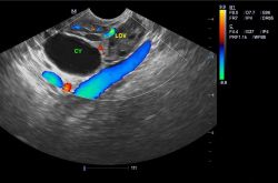 卵巢囊肿的最佳治疗 这些不良习惯易得卵巢囊肿哦