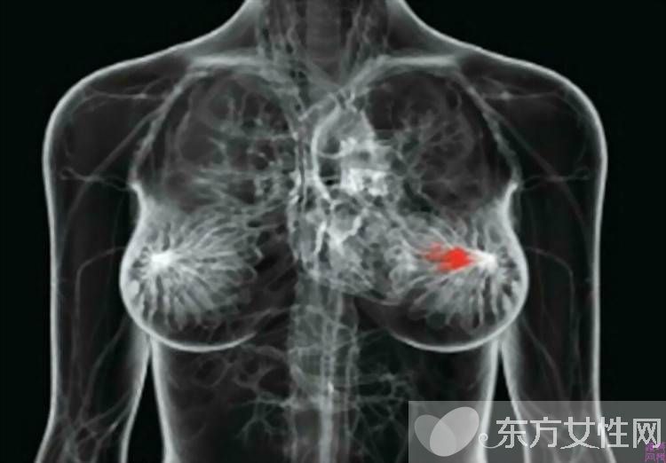 乳腺癌早期症状表现 日常如何自查乳腺癌