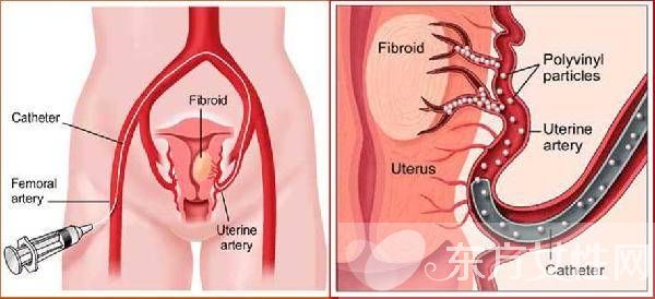 子宫肌瘤的症状表现 子宫肌瘤的危害居然这么大
