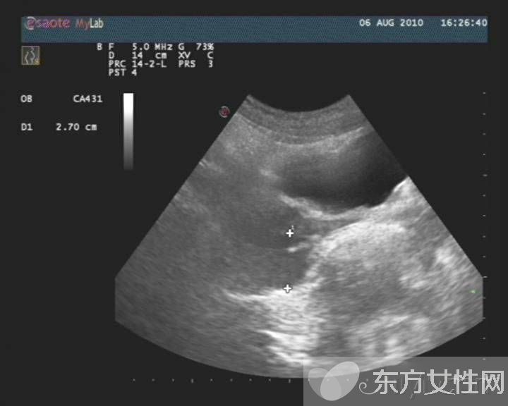 盆腔炎症状表现以及治疗 盆腔炎的危害居然这么大