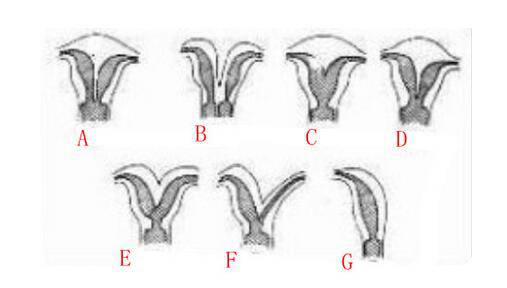 子宫畸形怎么办 它的危害居然这么大