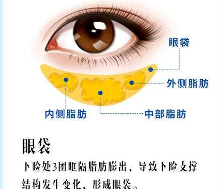 去眼袋