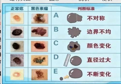 切痣2.jpg