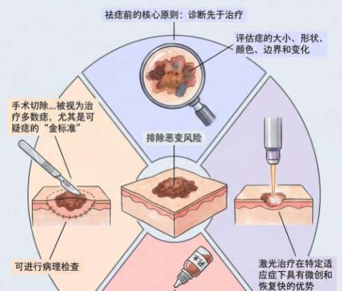 切痣1.jpg