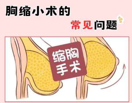 缩胸 缩胸