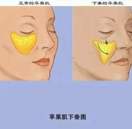 苹果肌复位3.jpg