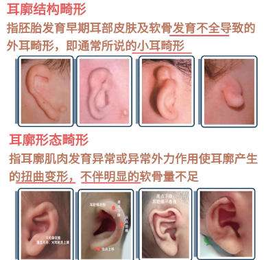 耳整形 耳整形