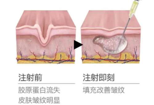 注射胶原蛋白