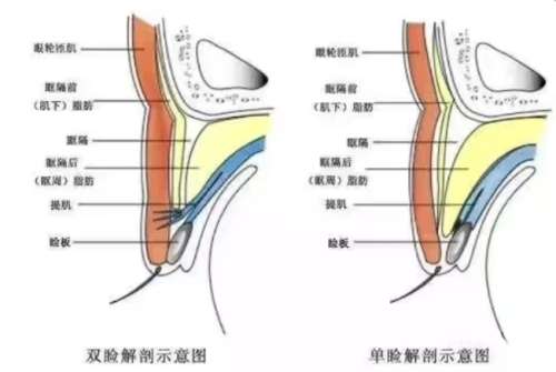 双眼皮