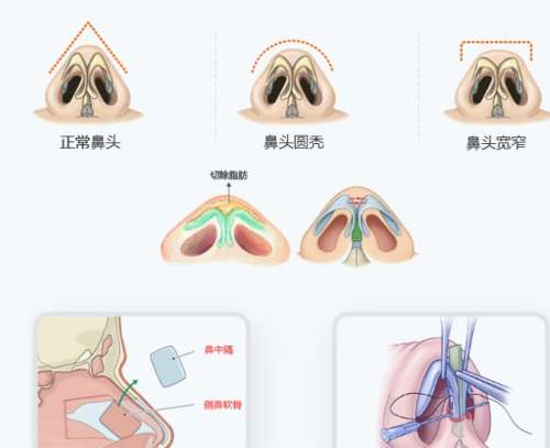 鼻综合 鼻综合